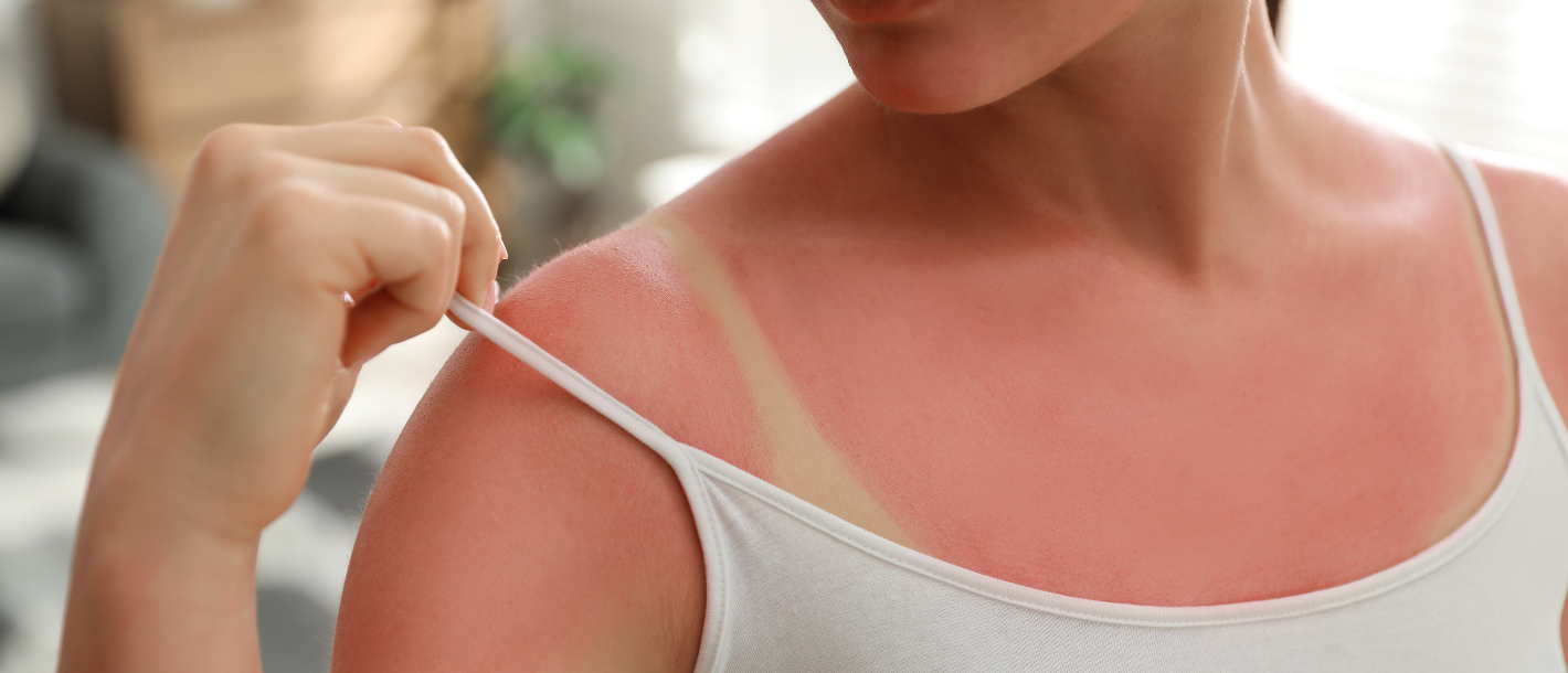 How to care for your skin after getting a sunburn