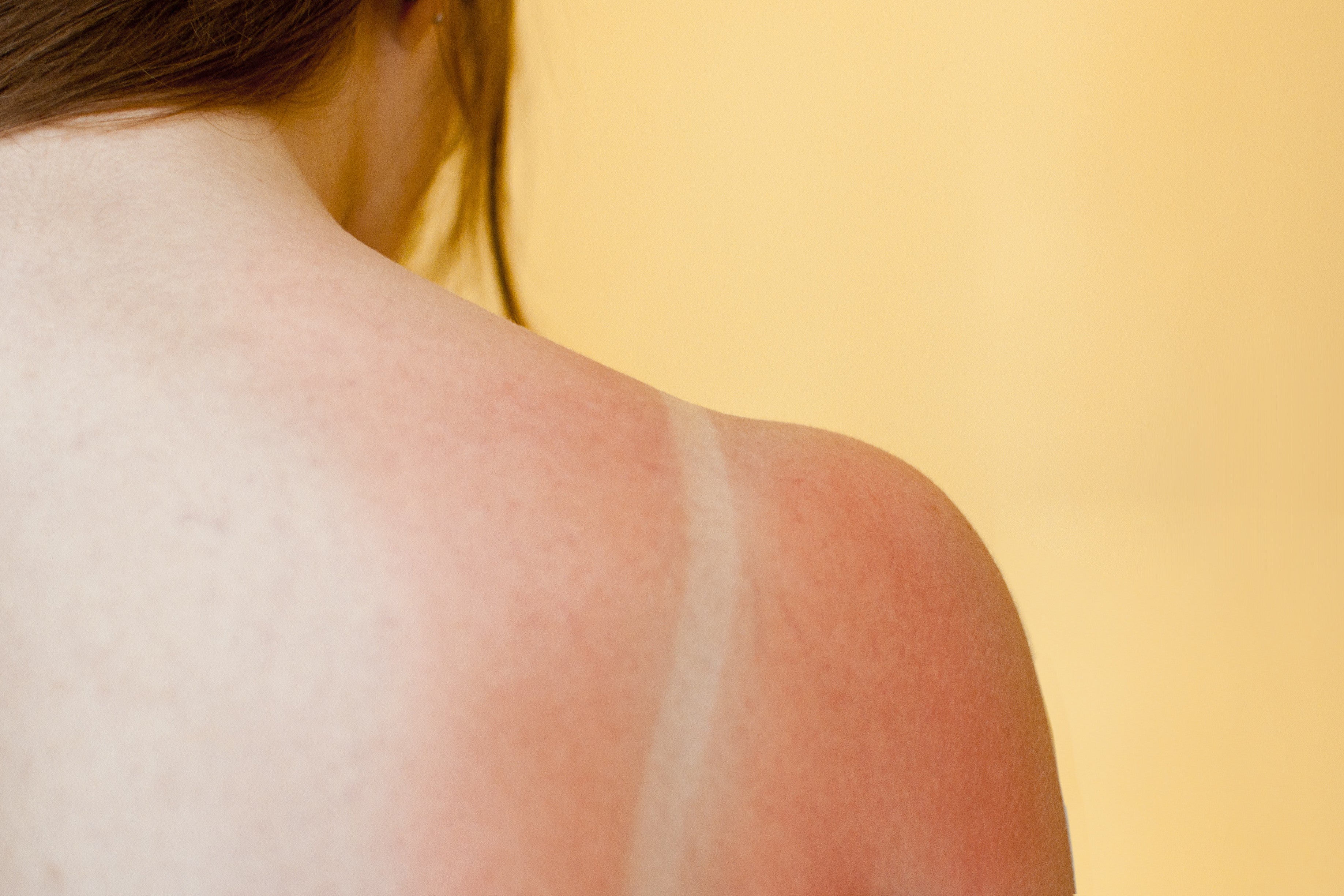 Brush On Block image of sun burn lined bathing suit on shoulders
