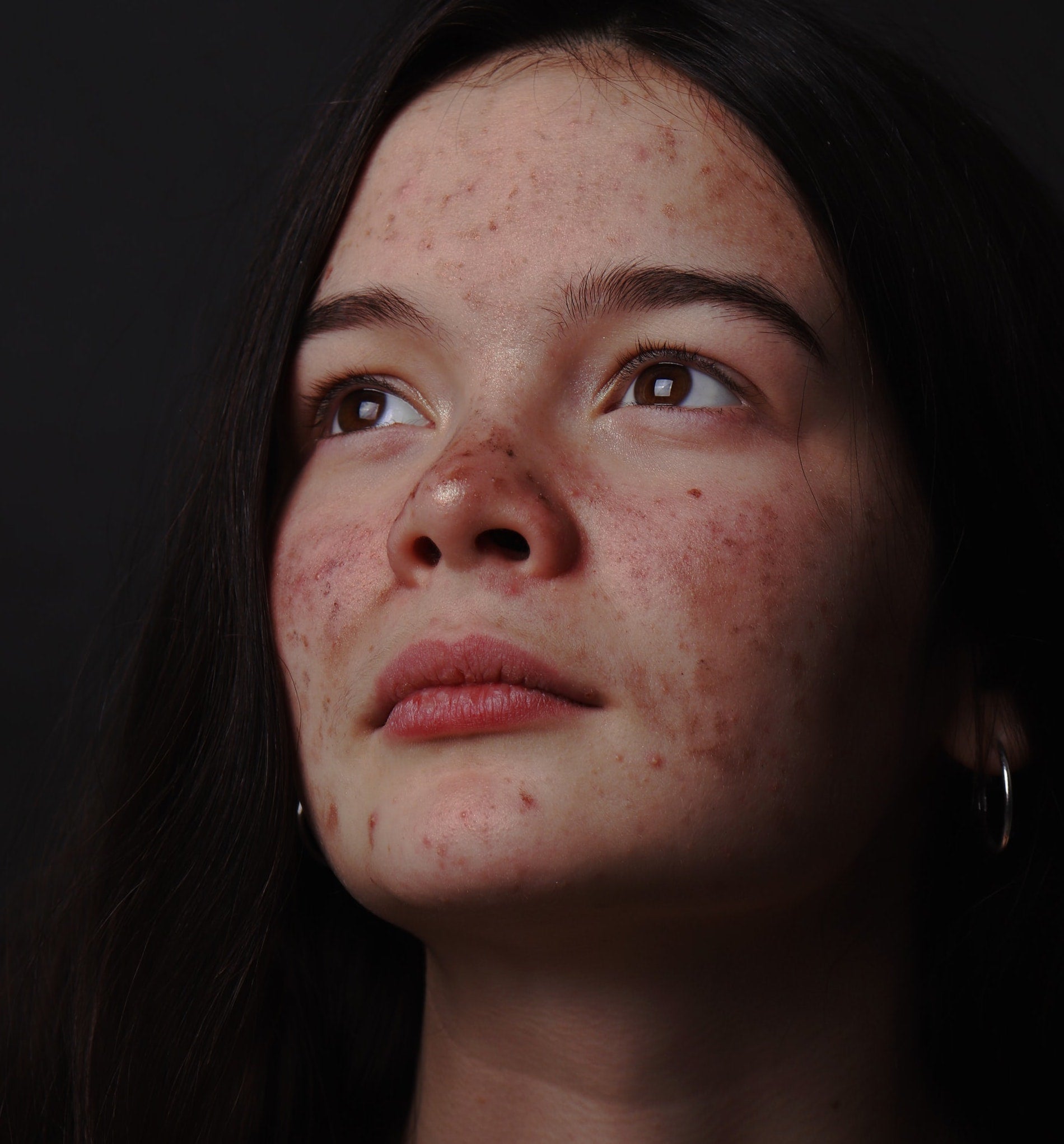 Photo of young woman with facial acne on dark background.